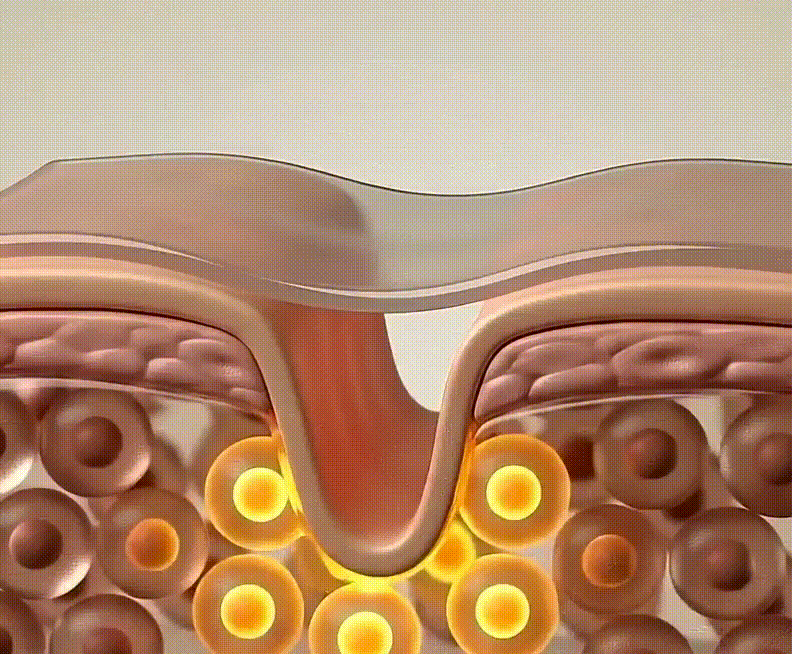 Finally Watch That Old Mark Fade — Without Lasers, Needles, or Tape That Falls Off